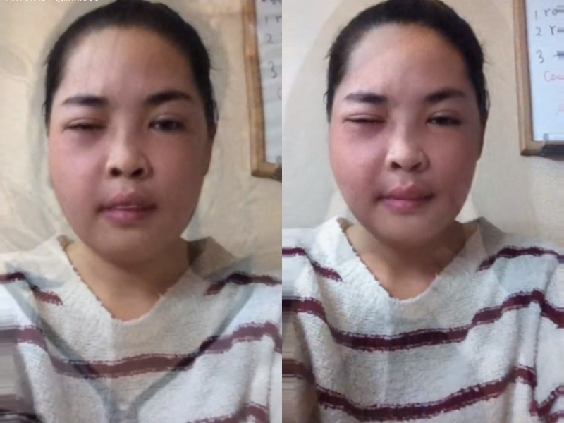  
2015 trở thành bước ngoặt trong cuộc đời của cô nàng gốc Nam Định. Trong bức ảnh đăng tải, có thể thấy gương mặt Thanh Quỳnh vẫn còn sưng do cắt mắt, sửa hàm và tiêm filler. (Ảnh: Chụp màn hình)
