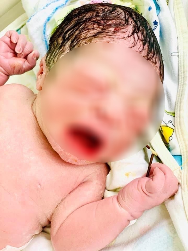  
Chiếc vòng tránh thai được em bé nắm chặt trong tay khi vừa mới lọt lòng đã trở thành hình ảnh gây sốt "rần rần" mạng xã hội. (Ảnh: Khoa sản 2 - Bệnh viện Đa Khoa Quốc tế Hải Phòng)