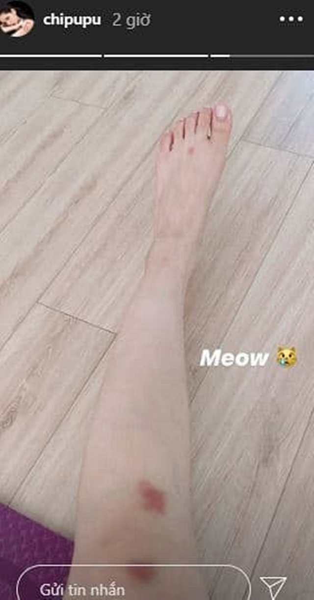  
Hình ảnh đôi chân nhiều vết bầm được giọng ca Từ hôm nay chia sẻ trên Instagram Story. (Ảnh: Chụp màn hình)