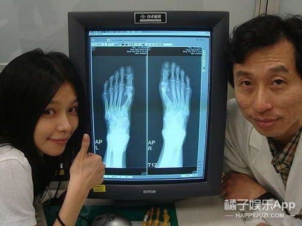  
Để có được đôi chân bình thường, nhiều nghệ sĩ phải chịu đau đớn thực hiện phẫu thuật (Ảnh Weibo)