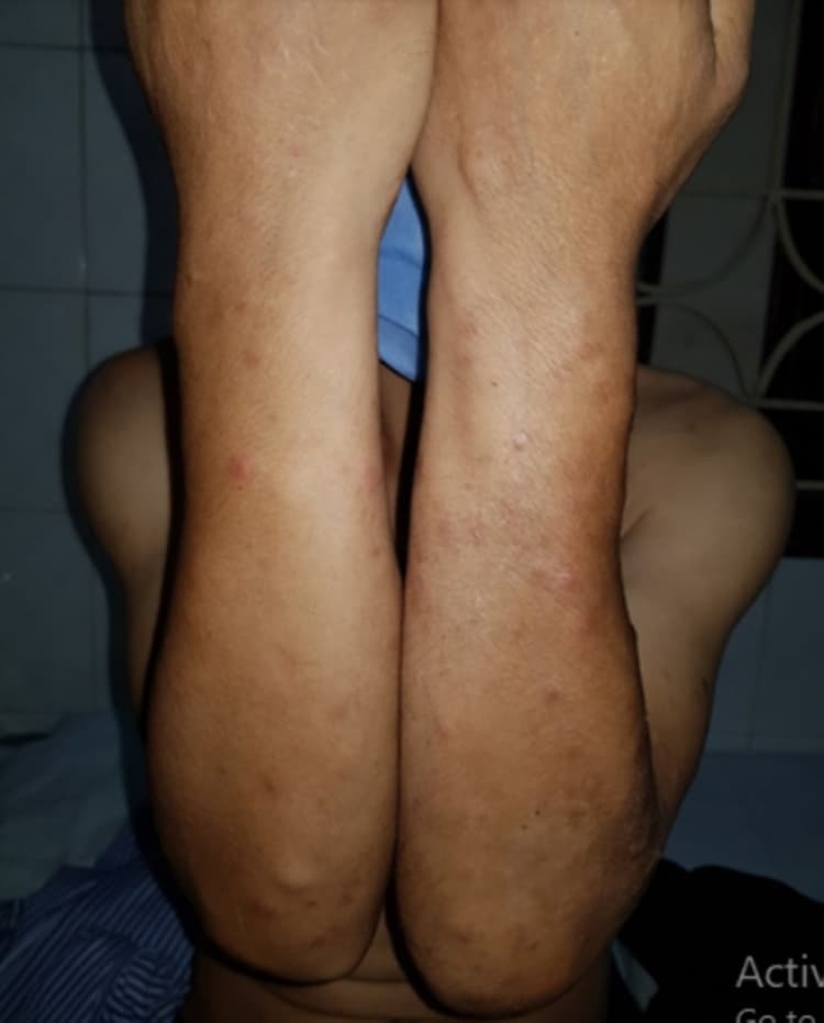  
Những nốt sần xuất hiện trên cánh tay của bệnh nhân mắc bệnh phong (Ảnh: Vietnamnet)