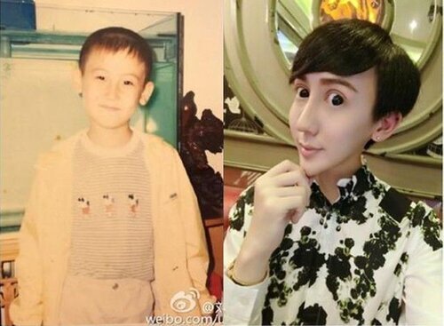  
Hình ảnh thời thơ ấu và sau khi có gương mặt khác lạ của anh (Ảnh: Weibo)