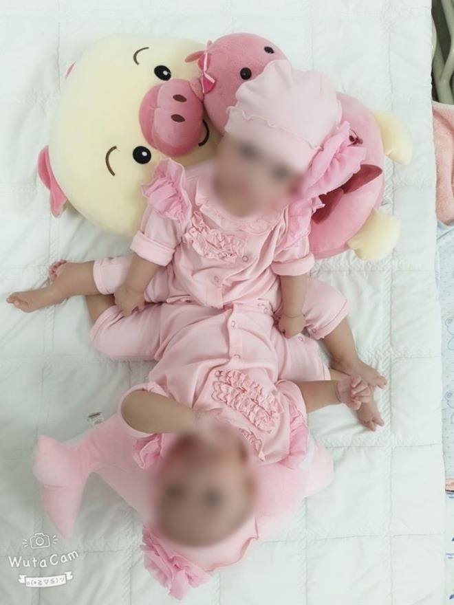  
Hình ảnh của 2 bé gái song sinh dính liền (Ảnh:VTC News)