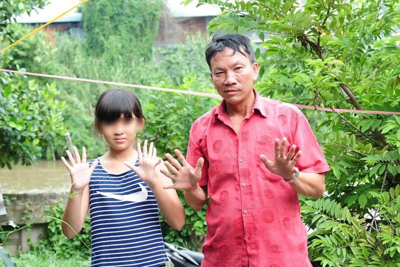  
Hình ảnh hai cha con ông Trần Thanh Tòng ở An Giang với bàn tay 6 ngón. (Ảnh: Thanh niên)