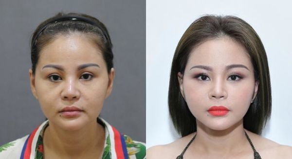
Sự khác biệt trước và sau khi đi Hàn Quốc phẫu thuật của nghệ sĩ (Ảnh: T.H)