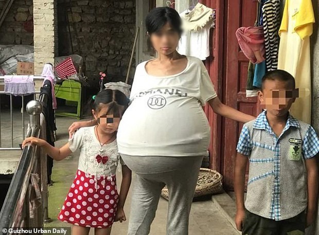  
Các con cô còn nhỏ nhưng đã phải giúp mẹ nhiều việc vì chiếc bụng gây cản trở không nhỏ cho sinh hoạt của cô Hoàng. Ảnh: Guizhou Urban Daily