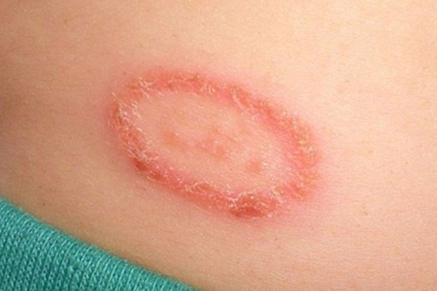  
Hình ảnh da bị tổn thương do tiếp xúc với chất độc của kiến ba khoang (Ảnh: Dân Việt)