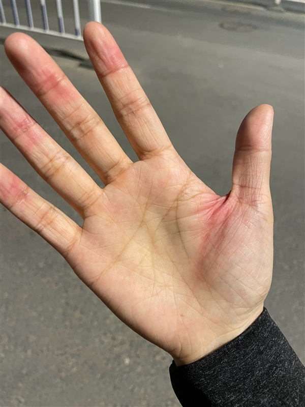  
Bàn tay in hằn vết khi nắm chặt chiếc iPhone 12 quá lâu (Ảnh: Weibo)