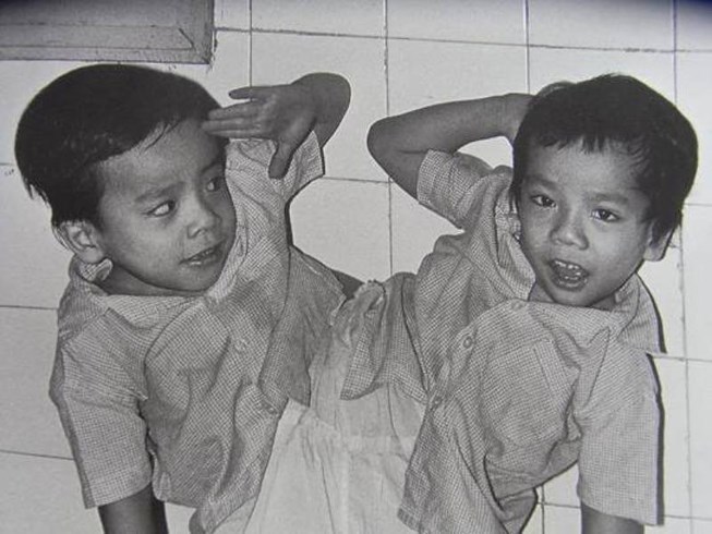  
Hai anh em Đức và Việt trước khi mổ tách dính năm 1988. Cuộc phẫu thuật đánh dấu mốc son cho nền y học Việt Nam với Kỷ lục Guinness năm 1991 và là đề tài được truyền thông Quốc tế nhắc lại nhiều lần. (Ảnh: Vietnamnet)