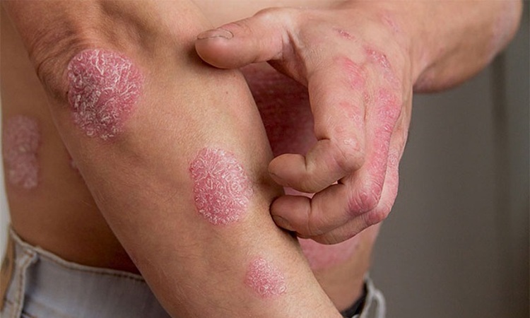 
Các mảng đỏ xuất hiện trên da người bị bệnh vảy nến (Ảnh: Vietnamnet)
