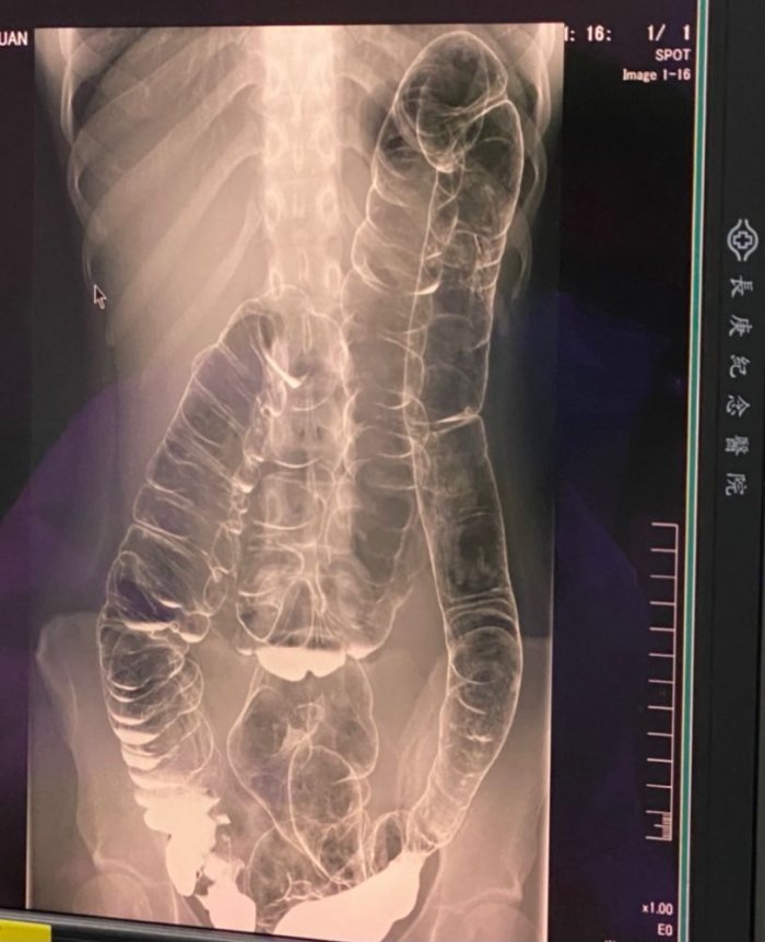  
Hình ảnh chụp X-quang của cô gái tại bệnh viện. (Ảnh: Dcard)