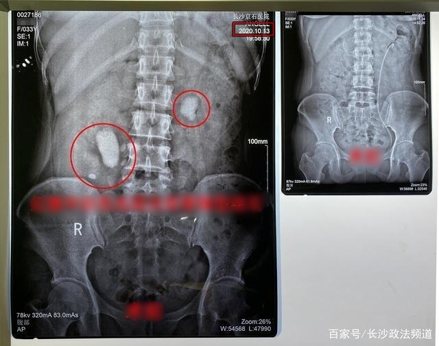  
Hình chụp X-quang vào ngày 13/10 của cô Dương. (Ảnh: Kknews)