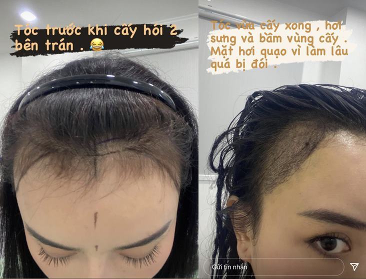  
Cô nàng chia sẻ hình ảnh trước và sau khi cấy tóc vài ngày. (Ảnh: FBNV)