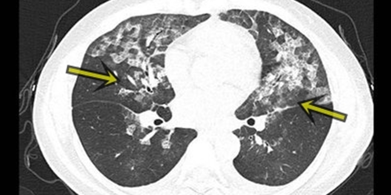  
Hình chụp CT phổi của bệnh nhân. (Ảnh: FNN)