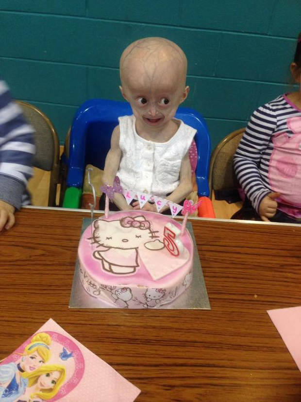  
Những trường hợp mắc phải căn bệnh Hutchinson Gilford Progeria thường chỉ có thể sống đến 13 tuổi. (Ảnh: Twitter)