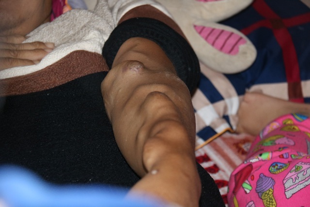  
Cánh tay của anh Ninh sau 8 năm điều trị bệnh giờ chi chít những khối u. (Ảnh: Dân Trí)