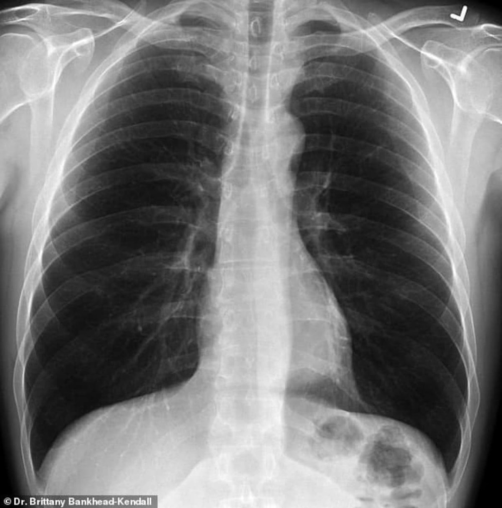 
Hình ảnh chụp X-quang phổi của người bình thường được đem ra so sánh. (Ảnh: Daily Mail)