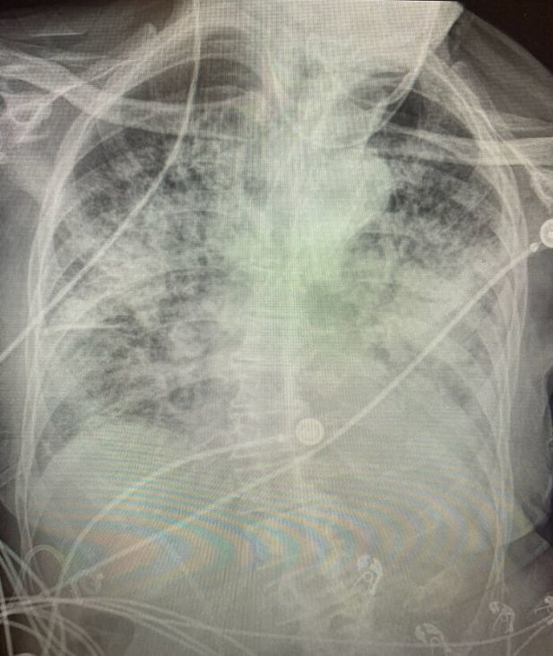 
Tình trạng phổi của bệnh nhân Covid-19 còn tệ hại hơn khi gần như trắng xóa. (Ảnh: Daily Mail)