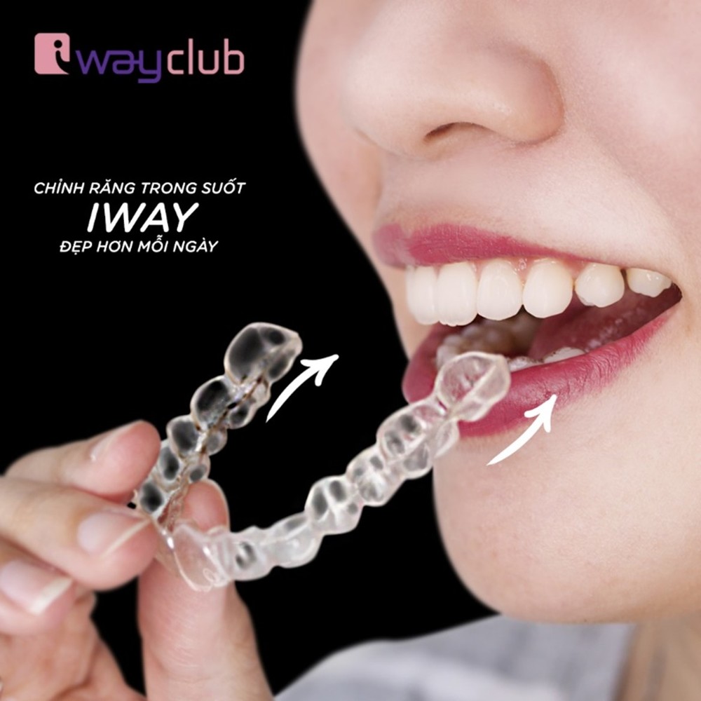 Niềng răng trong suốt của iWay Club – Công nghệ niềng răng thẩm mỹ vượt trội
