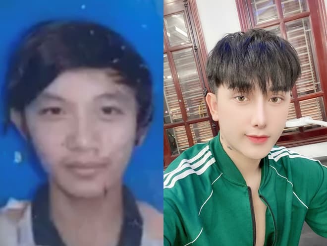 
Hình ảnh trước và sau khi thẩm mỹ của chàng trai trẻ. (Ảnh: IG)