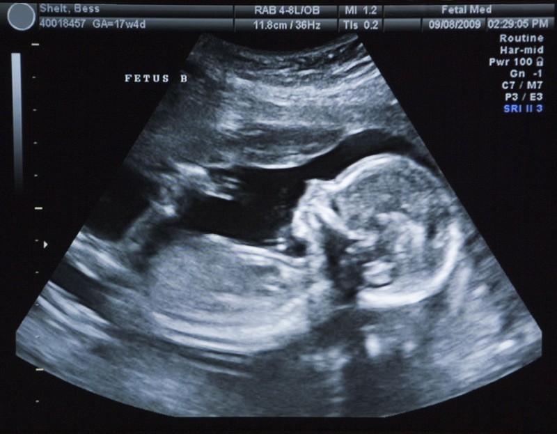  
Hình ảnh siêu âm thai nhi có thể giúp phát hiện ra các dị tật từ khi còn trong bụng mẹ. (Ảnh minh họa: VnExpress)