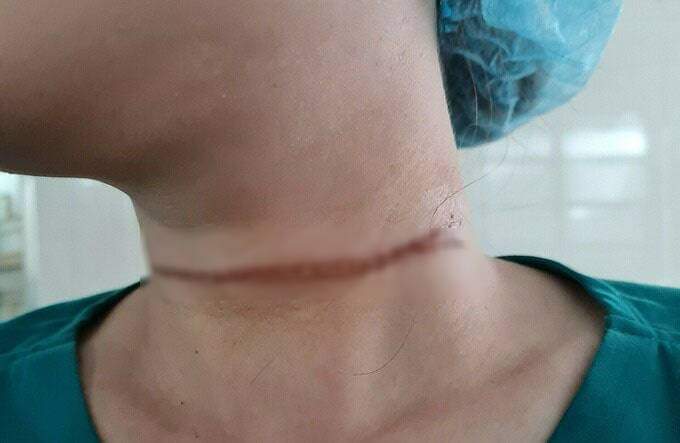  
Vết thương trên cổ chị N. do dây diều gây ra. (Ảnh: VnExpress)