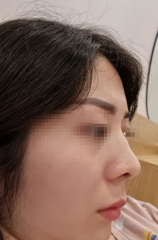  
Hình ảnh mũi của H. sau khi "trùng tu". (Ảnh: T.H.)