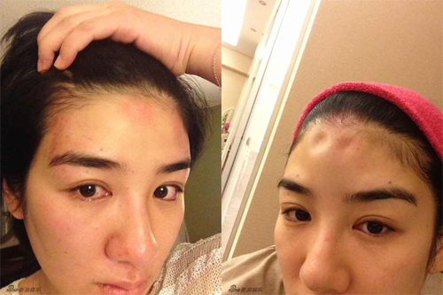  
Nữ diễn viên tung bằng chứng bị chồng bạo hành. (Ảnh: Weibo)