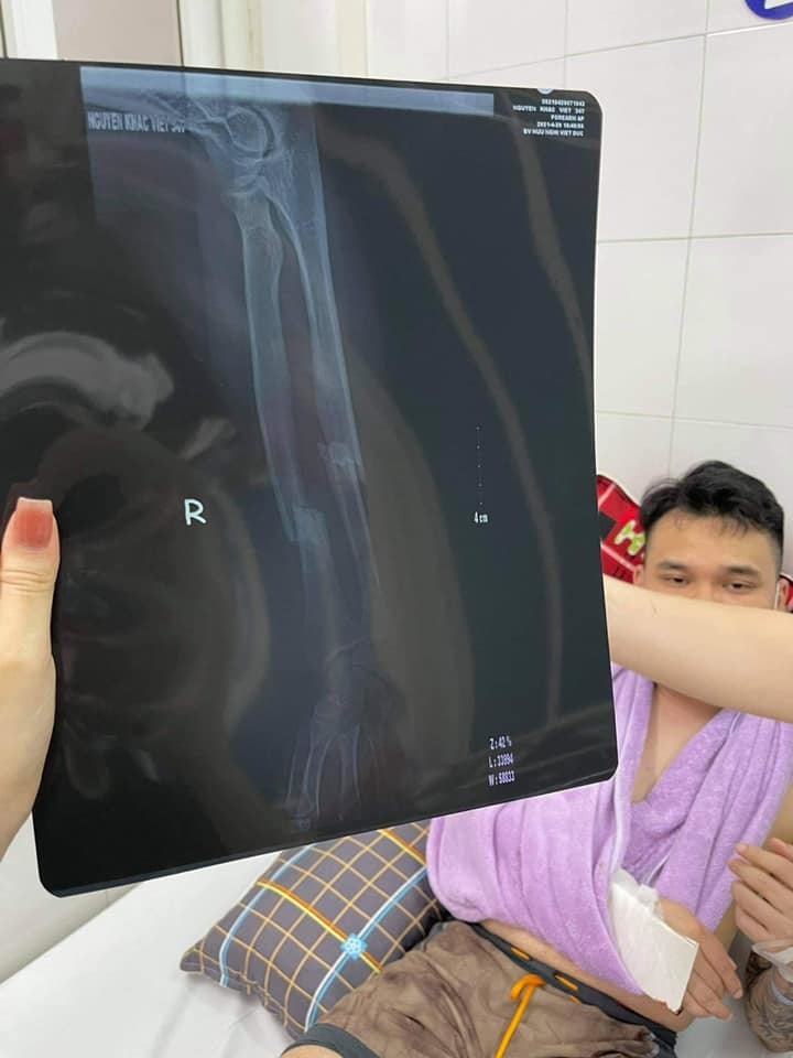  
Hình ảnh chụp X quang phần xương bị gãy của Khắc Việt. (ảnh: FBNV)
