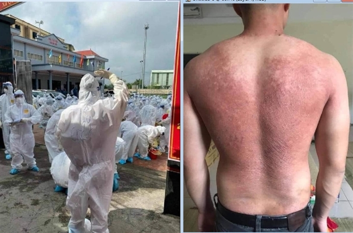  
Ảnh chụp tấm lưng phồng rộp của một bác sĩ do mặc đồ bảo hộ nhiều giờ liền dưới thời tiết oi bức. (Ảnh: VTC News)