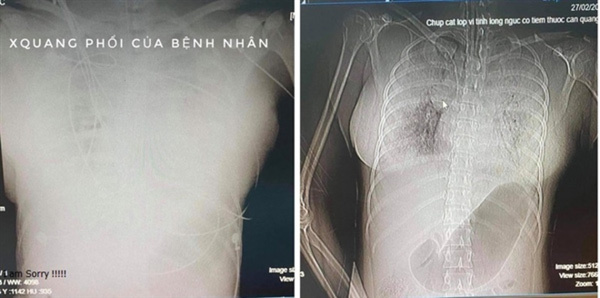  
Hình ảnh chụp X-quang và CT cho thấy phổi bệnh nhân đông đặc, xuất huyết nhiều. (Ảnh: Vietnamnet)