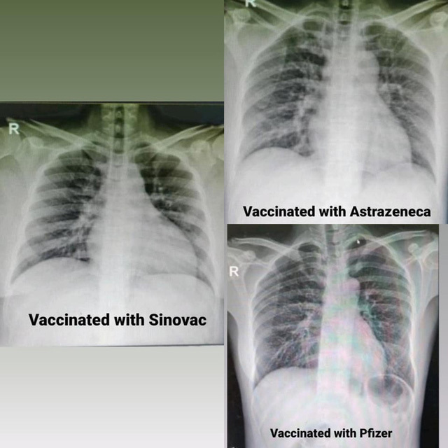 
Ảnh X-quang phổi của ba bệnh nhân mắc Covid-19 nhưng đã từng tiêm đủ liều vaccine. (Ảnh: Anne Gabriel-Chan)