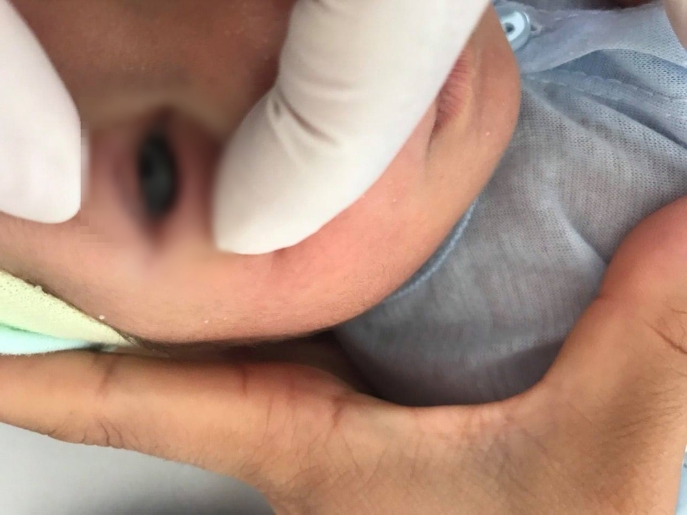  
Tình trạng mắt của em bé khi nhập viện. (Ảnh: Bệnh viện Sản Nhi Vĩnh Phúc)