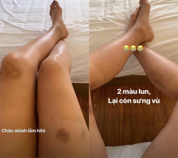  
Đôi chân đầy thương tích của Kỳ Duyên sau màn "chơi hết mình" tại Cuộc đua kỳ thú 2019. (Ảnh: Chụp màn hình)