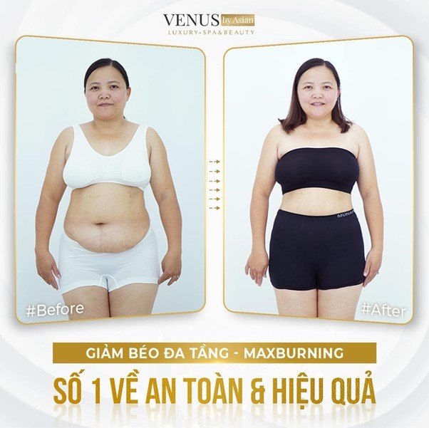  
Chị Hoà chọn Giảm béo đa tầng MaxBurning, với mong muốn giảm mỡ nhanh chóng, an toàn