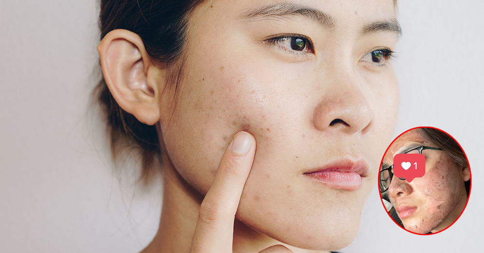 Việc can thiệp peel da có thể khiến người dùng bị bong tróc, hư tổn nặng nề. (Ảnh: FB T.N)