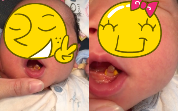  
Trẻ mọc răng bẩm sinh thường được khuyên nên nhổ bỏ. (Ảnh: Nhịp Sống Việt)