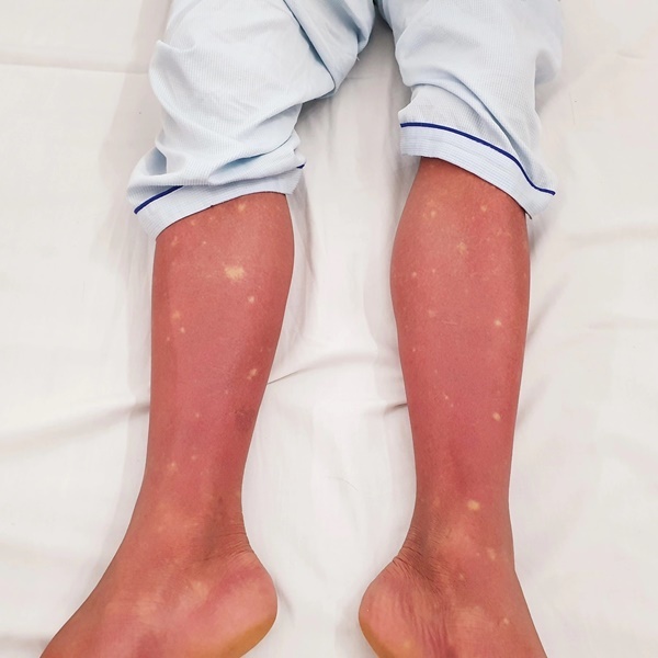  
Chân của bệnh nhân sốt xuất huyết chuyển sang màu đỏ. (Ảnh: Zing News)