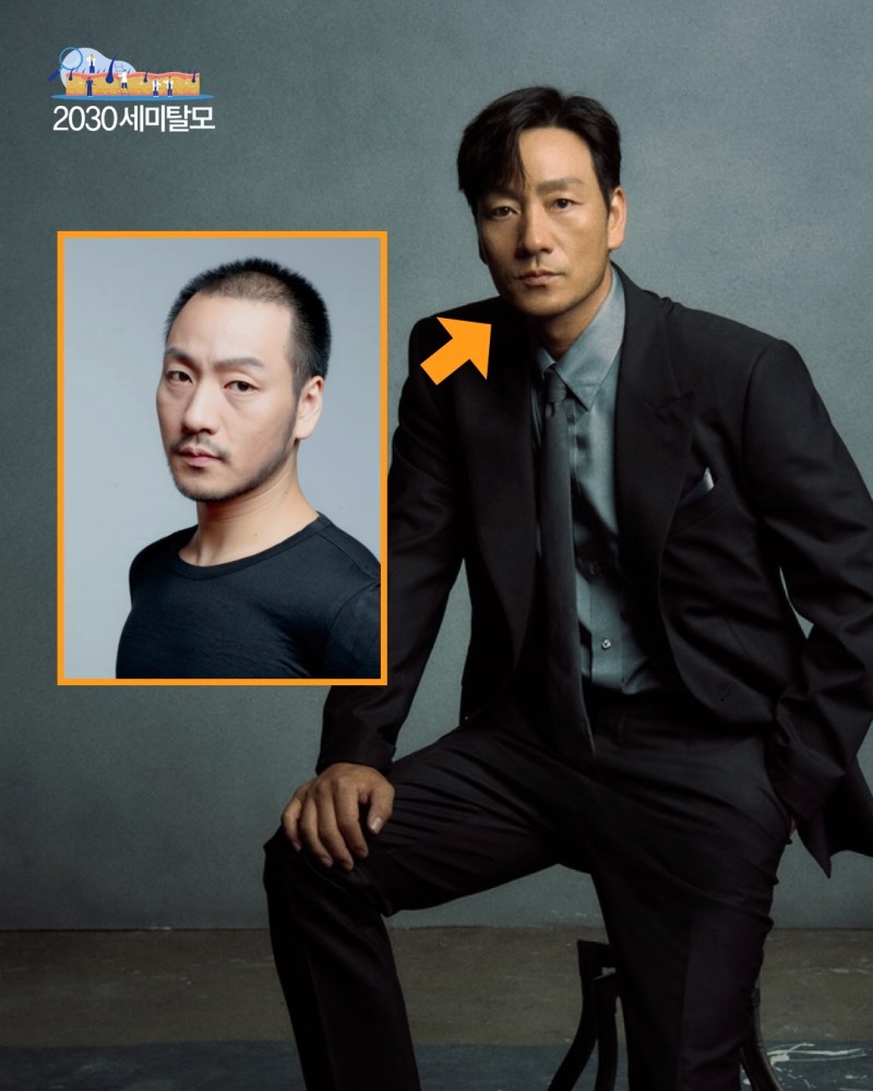    Hình ảnh trước và sau khi cấy tóc của nam tài tử. 