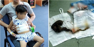 TP.HCM: Cấp cứu bé gái 7 tuổi nguy kịch vì thích ăn tóc thay cơm