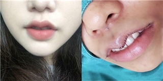 Khâu cắt bỏ mô thừa ở môi: Mốt làm đẹp “kinh dị” mới nổi