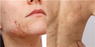 Mụn ở nhiều vùng trên cơ thể là dấu hiệu bệnh lý nguy hiểm