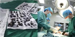 Tìm thấy 200 viên sỏi trong cơ thể người phụ nữ vì thói quen ai cũng mắc phải