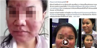 Ham dùng mỹ phẩm rẻ trên mạng, cô gái trẻ bị biến dạng gương mặt khủng khiếp