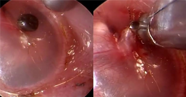 Ớn lạnh với sinh vật 8 chân quyết cố thủ trong màng nhĩ để “ăn thịt” vật chủ