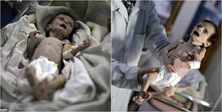 Cả thế giới rúng động trước hình ảnh em bé Syria suy dinh dưỡng nặng