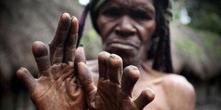Rùng rợn hủ tục cắt ngón tay để tang người chết của bộ lạc ở Indonesia
