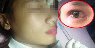Clip: Cô gái tiêm filler nâng mũi bị biến chứng teo nhãn cầu và dẫn đến mù lòa