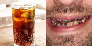 Nghiện đồ uống có ga, chàng trai phải trả giá "đắt" khi hàm không còn nổi một chiếc răng
