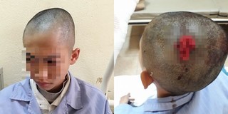 Quảng Ninh: Thầy giáo dạy thể dục bị tố đánh học sinh dã man đến mức tụ máu trên đầu phải nhập viện